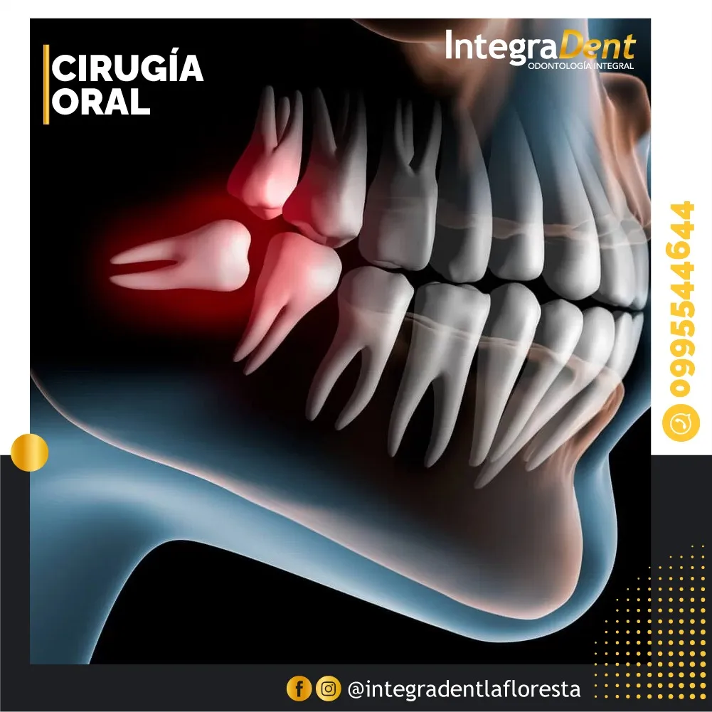 Cirugía Dental